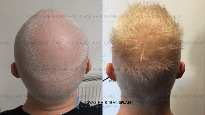 Civas Hair Transplant- FUE Hair Transplant Before & After Pictures (3500 Grafts) photo