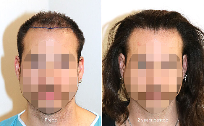 Case performed by Dr. Feriduni – 3346 FU in 1 procedure photo