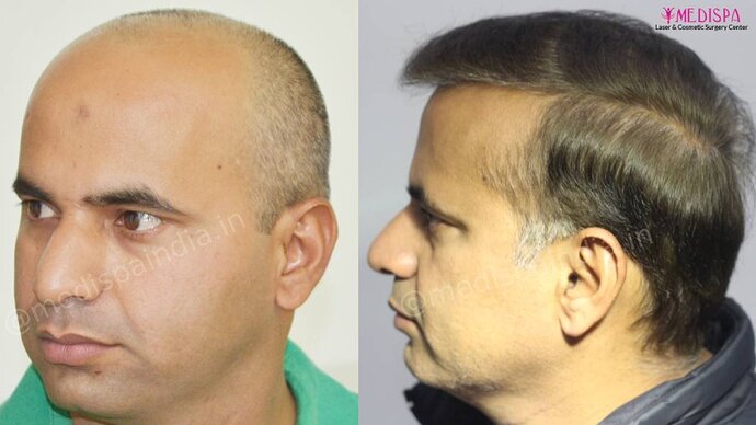 11600 Grafts in 3 FUT Sittings by Dr Suneet Soni photo