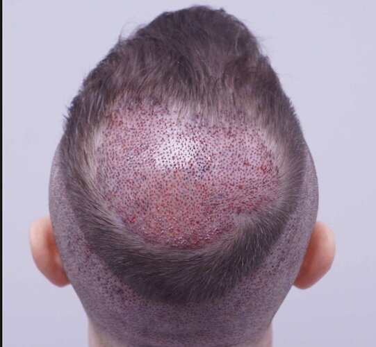 FUE Hair Transplant - 2,300 Grafts - Dr Bessam Farjo photo
