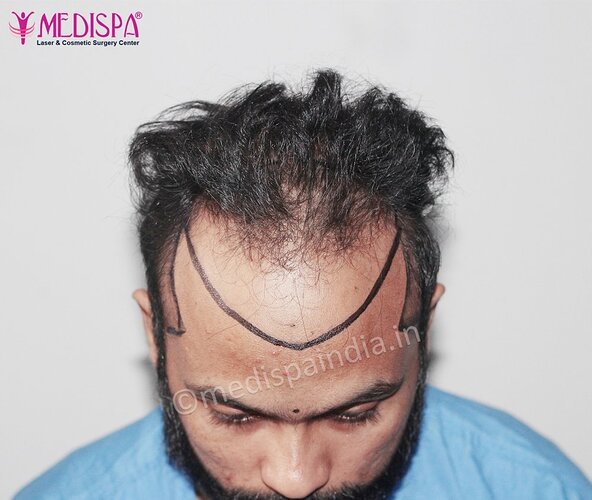 Dr. Suneet Soni - 5320 Grafts, Combine FUT + FUE Technique , NW- IV photo