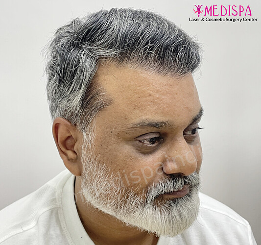 Dr. Suneet Soni - 4190 Grafts, Combine FUT + FUE + Beard Technique, NW- III photo