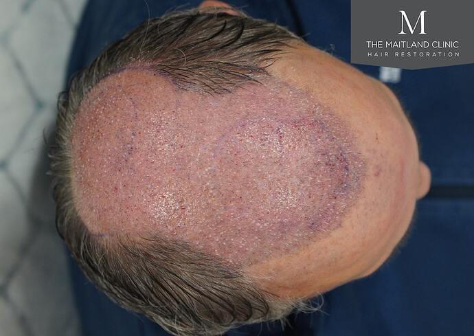 Dr Ball - The Maitland Clinic 2448 Grafts By FUT photo