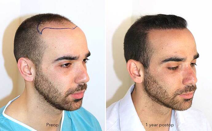 Case performed by Dr. Feriduni – 3505 FU in 1 procedure photo