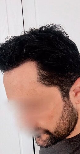 DR HAKAN DOGANAY/ 2000 GRAFTS / Implanter Pen+FUE photo