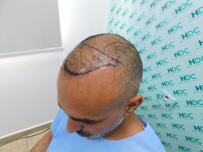 FUE repair Result after 6026 Grafts in two Sessions – HDC Hair Clinic – Dr Maras photo