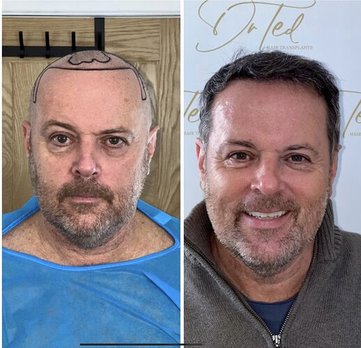 Dr Ted Miln (UK) | 6,120 grafts | FUT+FUE combo | Hairline, midscalp & crown restoration | 8.5 months post-op photo
