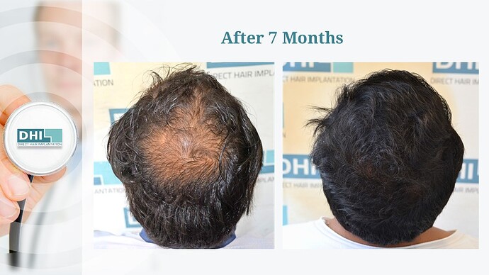 DHI India | NW Scale 5 | 4,353 Grafts | 07 Months DHI Hair Transplant Result photo