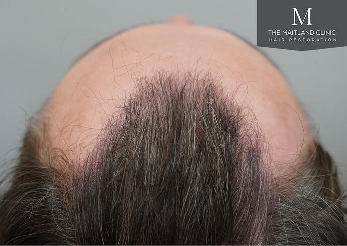 Dr Ball - The Maitland Clinic 2032 Grafts By FUE photo