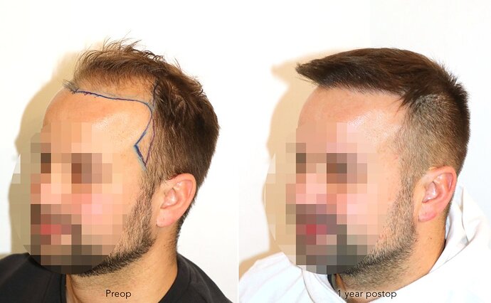 Case performed by Dr. Feriduni – 3726 FU in 1 procedure photo