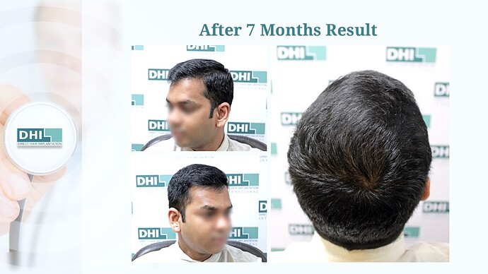 DHI India™ | NW 5 | 3,257 Grafts | 7 Months Hair Transplant Result photo