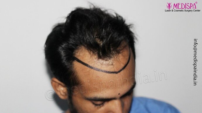 Dr. Suneet Soni - 3029 FUE Grafts, FUE Method (Trivellini System), NW - III photo