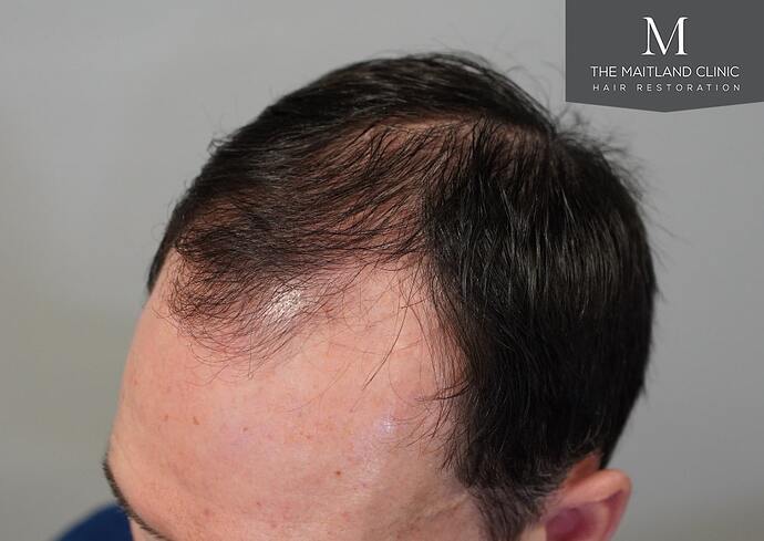 Dr Ball - The Maitland Clinic 1432 Grafts By FUE photo