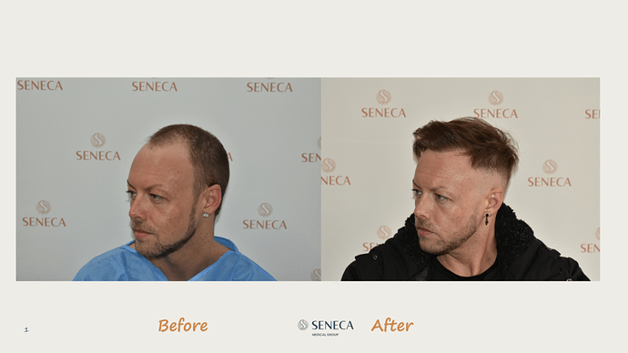 Seneca Medical Group - 3200 grafts with Direct Fue photo