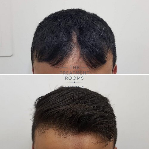 Hair Transplant Surgery for Linear Scleroderma 817 grafts photo