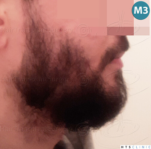 Dr. Jean Devroye, HTS Clinic / 1523 FUE / Beard to beard restoration photo