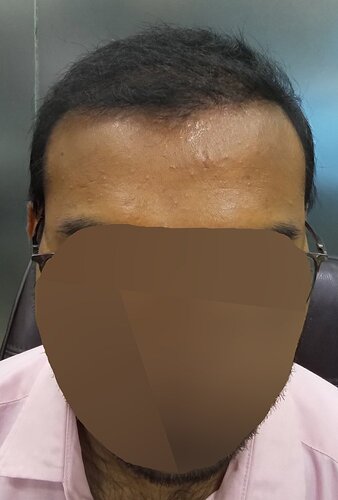 RA 133 - (7347 FUSE/Fue grafts) 5.5 months update photo