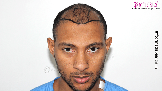 Dr. Suneet Soni - Afro Hair Transplant, 2 Sessions, 8355 Grafts, Combined FUT + FUE Technique, NW-VI, 5 Years Result photo