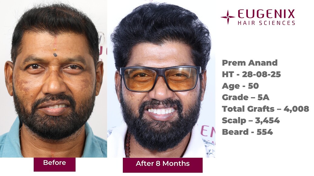https://cdn.forumhairtransplant.com/optimized/3X/5/c/5ca040ec7f94c6b97b934e19abcedb591f8d00a9_2_1035x582.jpeg