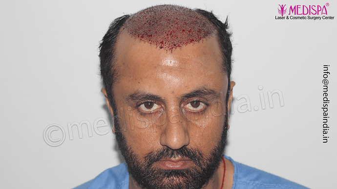 Dr. Suneet Soni - 5334 Grafts, Combine FUT + FUE + BHT (Beard) Technique, NW- V photo