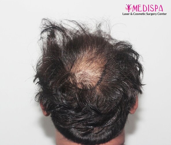 Dr. Suneet Soni - 5000 Grafts, Combine FUT + FUE + BHT (Beard) Technique, NW-V, 2.5 Year Result photo