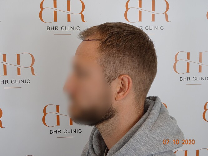 Dr.Bisanga, BHR Clinic Brussels 3251 FUE 0 - 8 Months photo