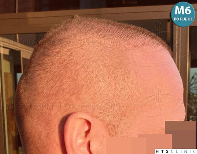 Dr. Jean Devroye, HTS Clinic / 5280 FUE (2008 + 2018 + 1254) / 3 sessions photo