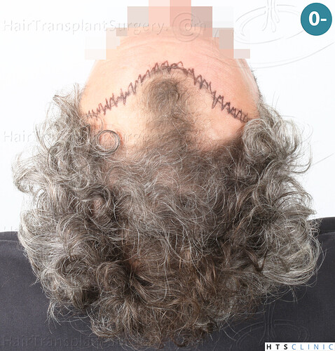 Dr Devroye + Dr Montesanti + Dr Jenard, HTS Clinic / 2932 FUE / Hairline & frontal area photo