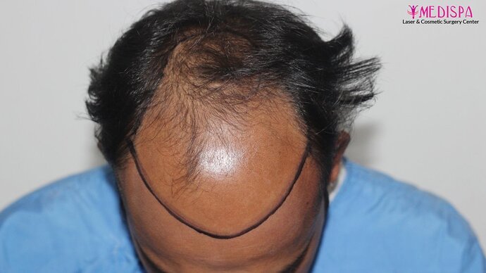 Dr. Suneet Soni - 5587 Grafts, Combine FUT + FUE + Beard Technique, NW : V-VI photo