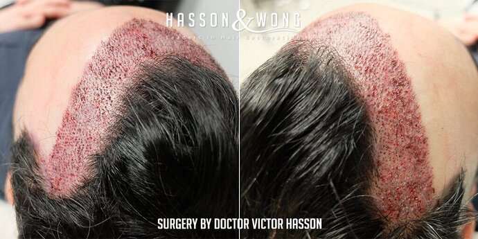 Dr. Hasson / 2,500 grafts / FUE / Hairline / 1 Year Post-op photo