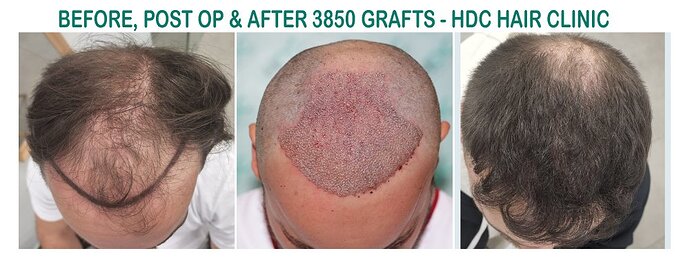 Result of FUE1 to front and top – Post op of Crown with 6055 Grafts – HDC Hair Clinic – Dr Christina photo