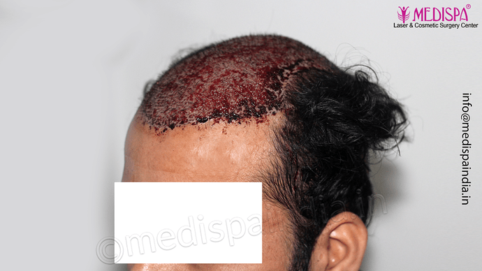 Dr. Suneet Soni - 5467 Grafts, Combine FUT + FUE + Beard Technique, NW- V, 3 Years Result photo