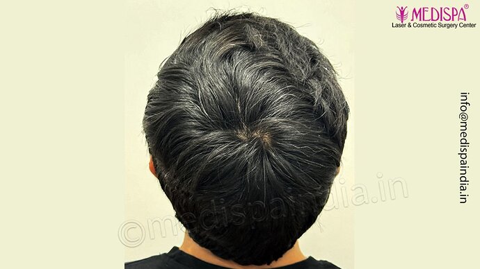 Dr. Suneet Soni - 3029 FUE Grafts, FUE Method (Trivellini System), NW - III photo