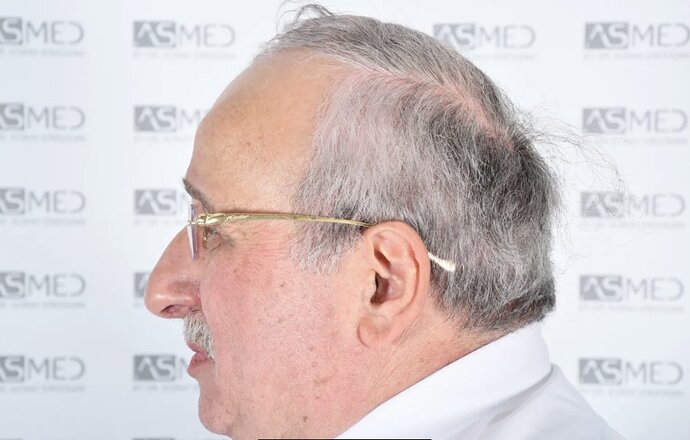Asmed Clinic - FUE - 4558 Grafts - 12 Month Result. photo
