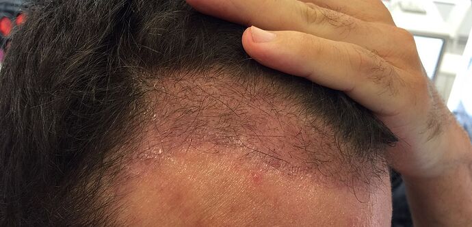 Dr. Bisanga - BHR Clinic / 2531 FUE - Manual Punch photo