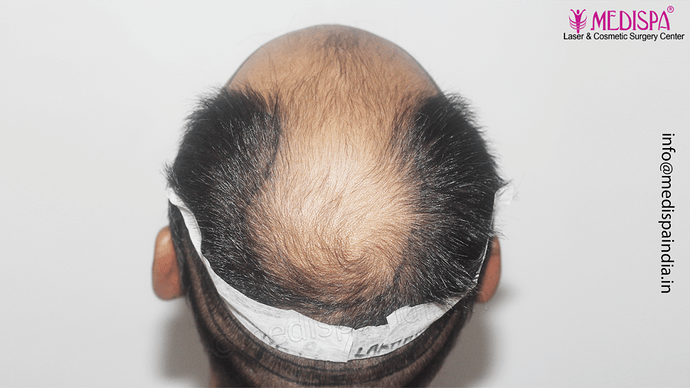 Dr. Suneet Soni - 4992 Grafts | 12-Month Result | Combination FUT + FUE + Beard photo
