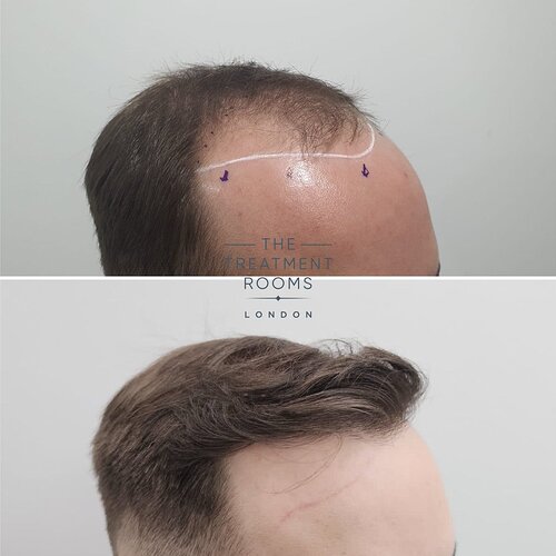 Result- Frontal Third FUE Hair Transplant- 2187 Grafts photo