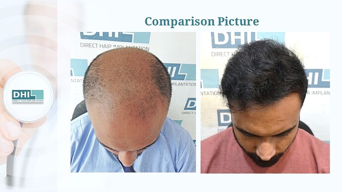 DHI India™ | NW 6 | 4,473 Grafts | 1-Year Hair Transplant Result photo