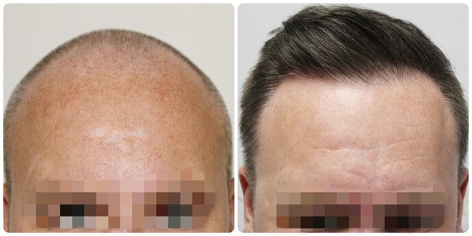 Dr Bonaros, Glasgow, UK / 4076 FUE grafts / 0-12 Months photo