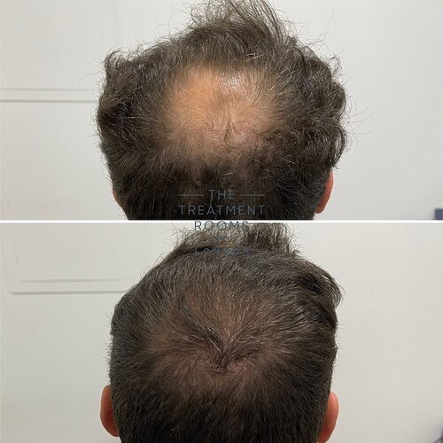 Crown and Hairline 1736 Grafts FUE Hair Transplant Result photo