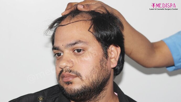 Dr. Suneet Soni - 4937 Grafts, Combine FUT + FUE Technique, NW : IV-V photo