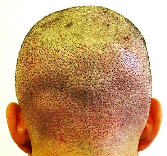 Dr. Bisanga, BHR Clinic, 3157 FUE / 0-10 Months photo