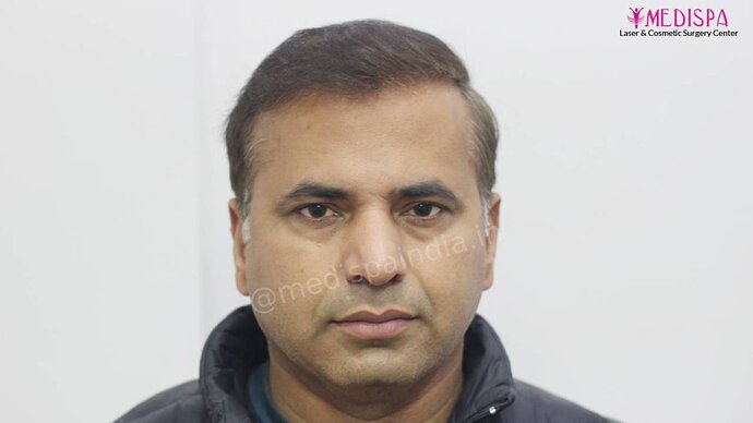 11600 Grafts in 3 FUT Sittings by Dr Suneet Soni photo