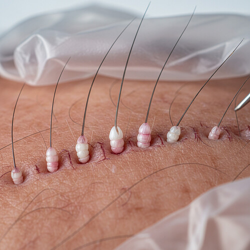 Microscopic view of hair follicle transplantation