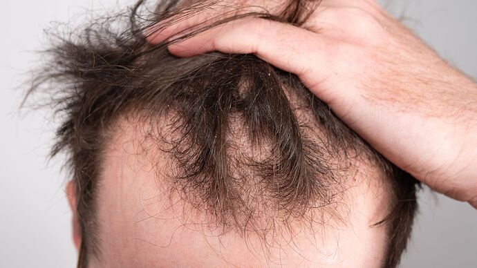 Extent of Hair Loss and Desired Outcome