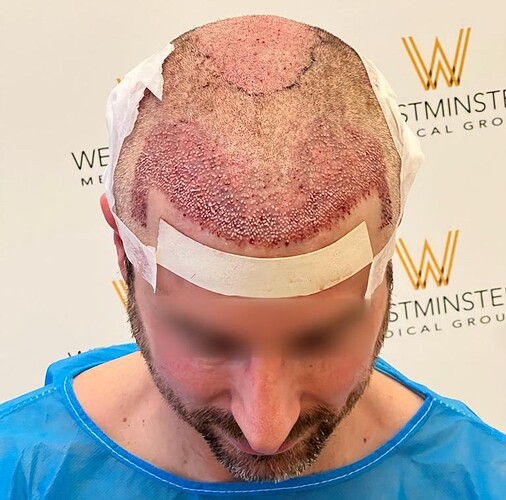 Westminster Medical Group London - 2539 Grafts - 12 Months Progress photo
