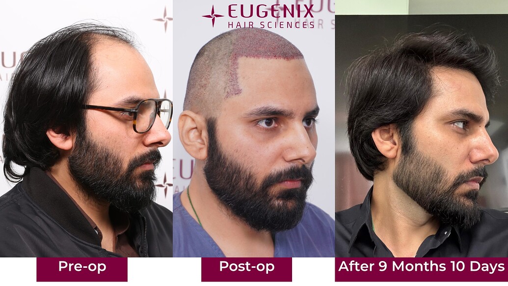 https://cdn.forumhairtransplant.com/optimized/3X/6/1/6101eac3bdc10fccebd4ef7870ea9f6d005c3cb1_2_1035x582.jpeg