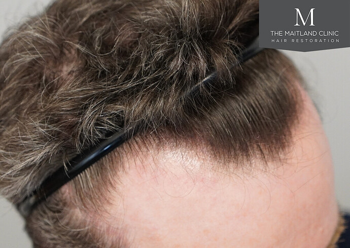 Before and after results: 1694 grafts by FUE at The Maitland Clinic (Dr Edward Maitland Ball) photo