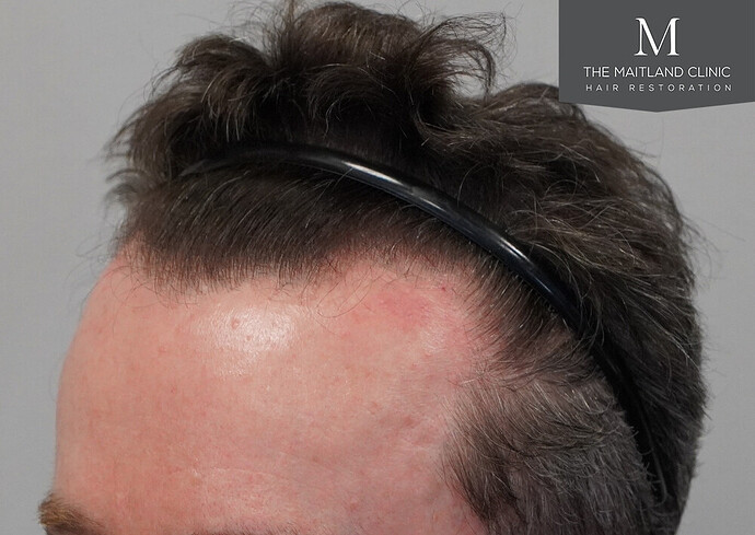 Before and after results: 1694 grafts by FUE at The Maitland Clinic (Dr Edward Maitland Ball) photo
