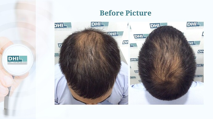 DHI India™ | Crowning Glory Restored | 2,650 Grafts | 8 Months Hair Transplant Result photo